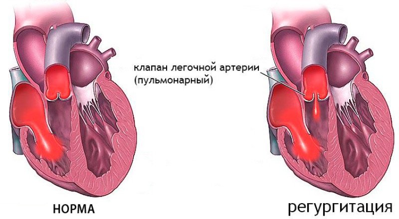 Легочная регургитация 1 степени что это такое у детей. Смотреть фото Легочная регургитация 1 степени что это такое у детей. Смотреть картинку Легочная регургитация 1 степени что это такое у детей. Картинка про Легочная регургитация 1 степени что это такое у детей. Фото Легочная регургитация 1 степени что это такое у детей